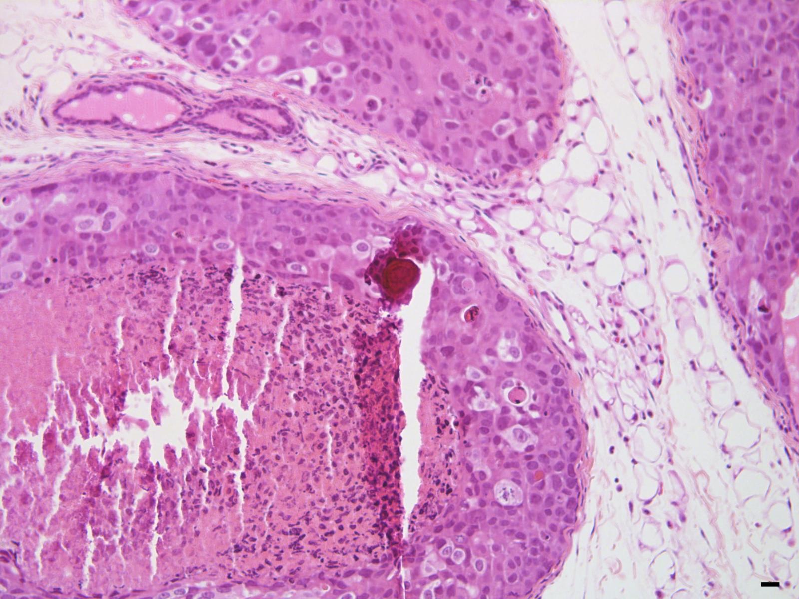 Mikroverkalkung, verursacht durch eine Östrogenrezeptor-positive Brustkrebszelllinie (MCF7), die intraduktal wächst