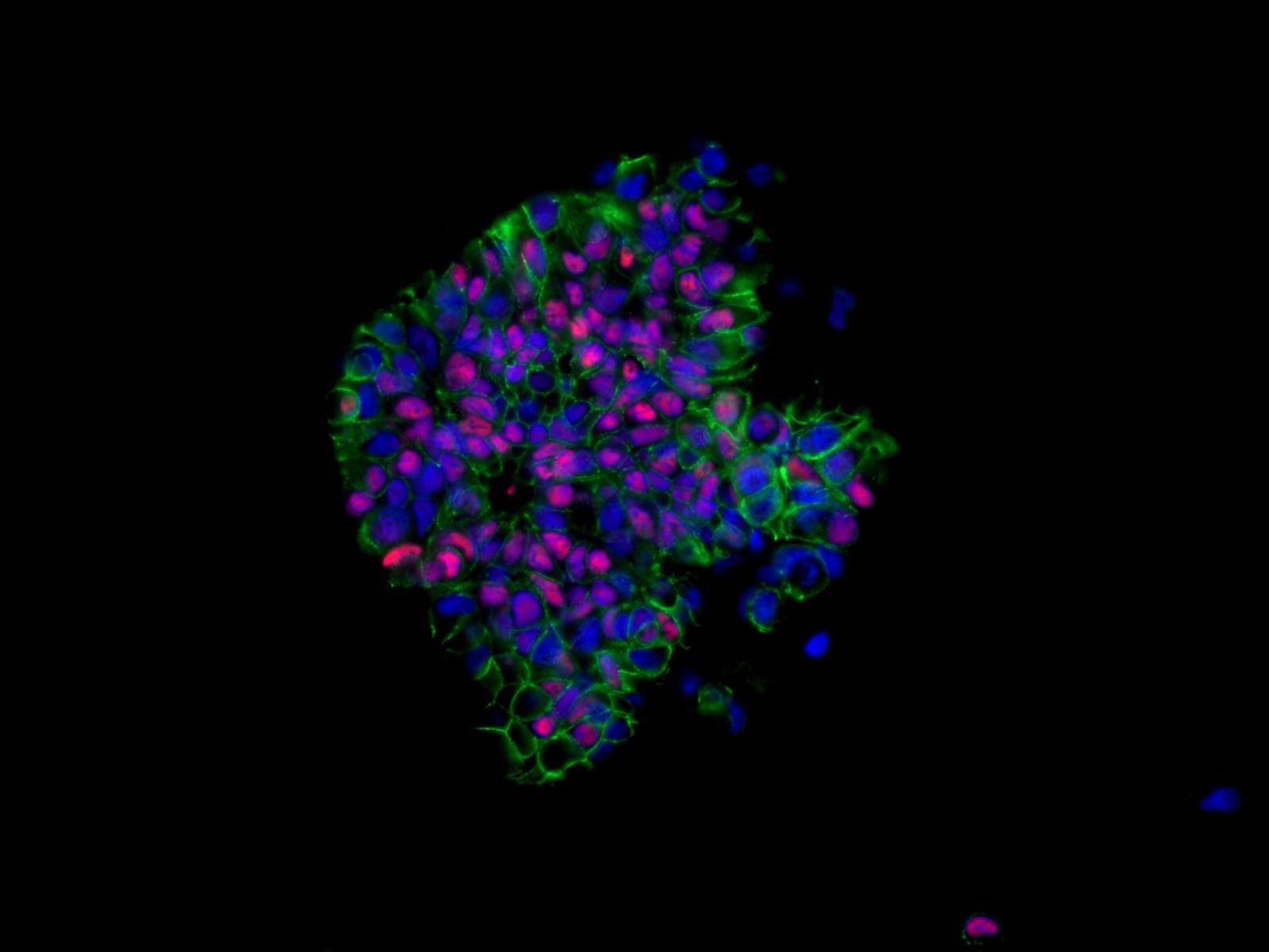 Recettori del progesterone in cellule di cancro al seno derivate da pazienti coltivate in matrici 3D